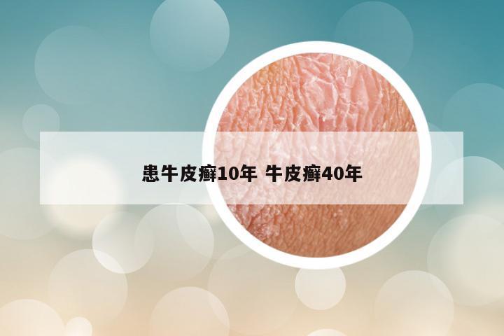 患牛皮癣10年 牛皮癣40年
