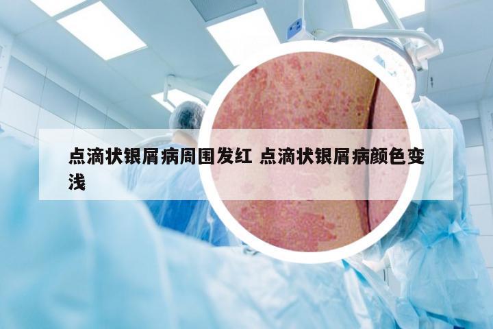 点滴状银屑病周围发红 点滴状银屑病颜色变浅