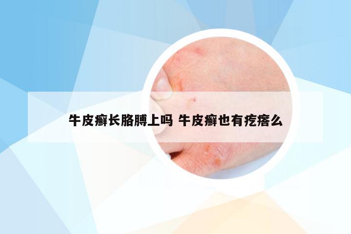 牛皮癣长胳膊上吗 牛皮癣也有疙瘩么