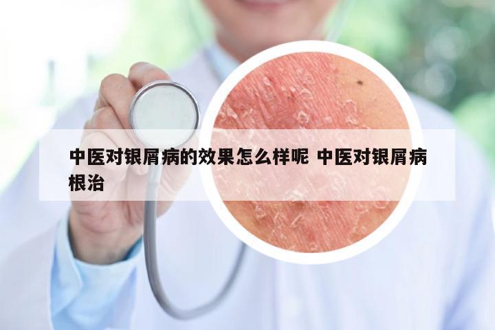 中医对银屑病的效果怎么样呢 中医对银屑病根治