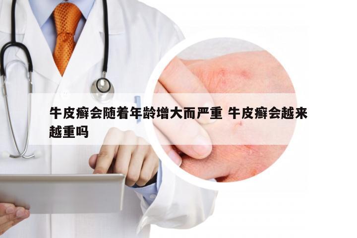 牛皮癣会随着年龄增大而严重 牛皮癣会越来越重吗