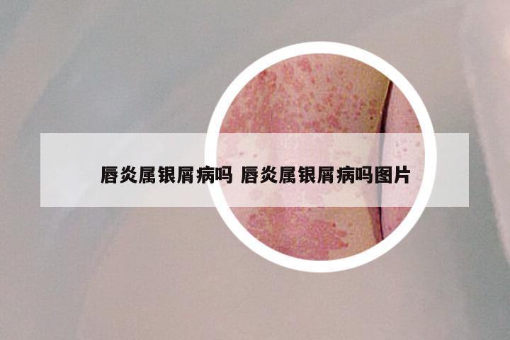 唇炎属银屑病吗 唇炎属银屑病吗图片