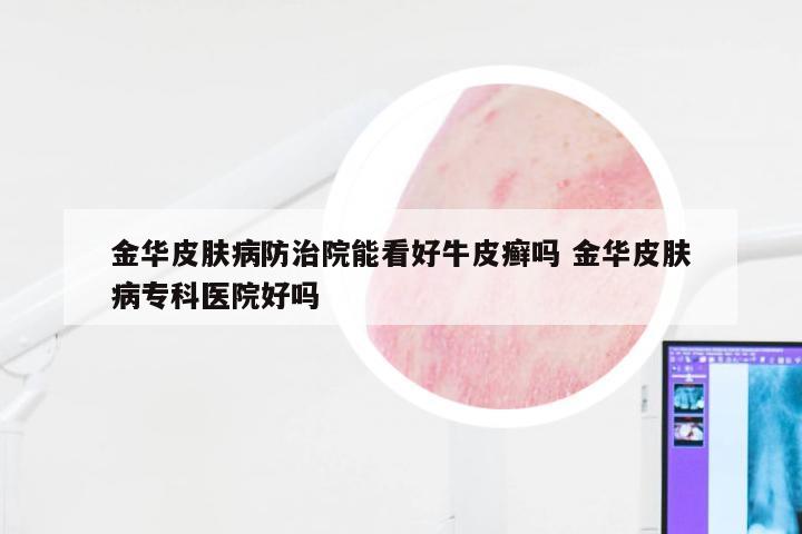 金华皮肤病防治院能看好牛皮癣吗 金华皮肤病专科医院好吗
