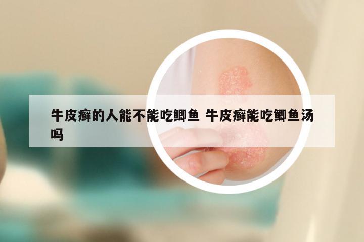 牛皮癣的人能不能吃鲫鱼 牛皮癣能吃鲫鱼汤吗