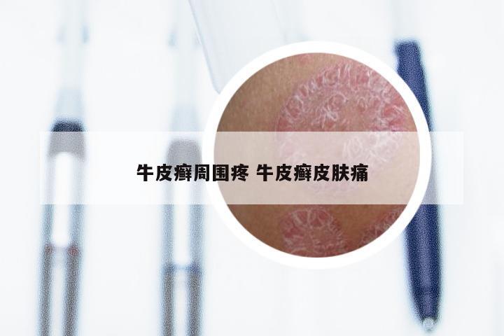 牛皮癣周围疼 牛皮癣皮肤痛