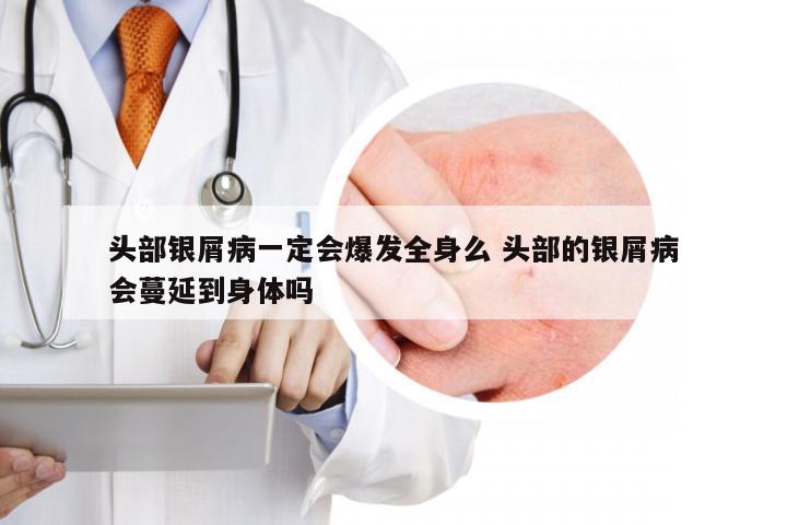 头部银屑病一定会爆发全身么 头部的银屑病会蔓延到身体吗