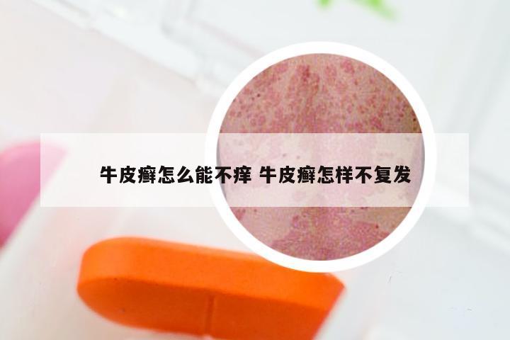 牛皮癣怎么能不痒 牛皮癣怎样不复发