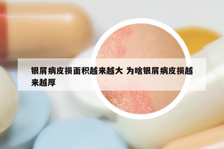 银屑病皮损面积越来越大 为啥银屑病皮损越来越厚