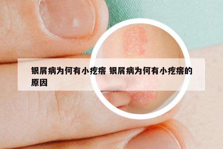 银屑病为何有小疙瘩 银屑病为何有小疙瘩的原因