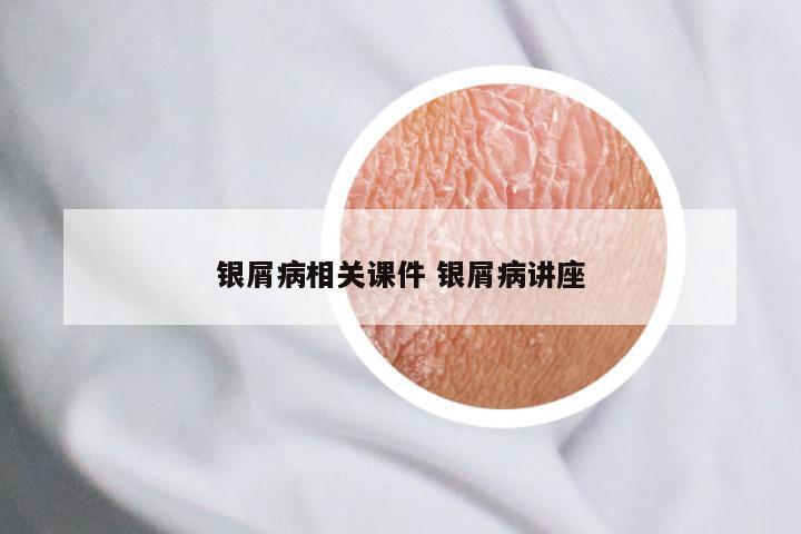 银屑病相关课件 银屑病讲座