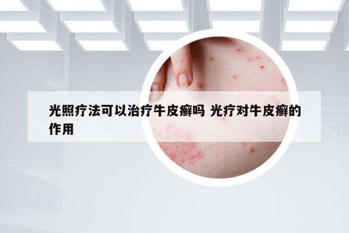 光照疗法可以治疗牛皮癣吗 光疗对牛皮癣的作用