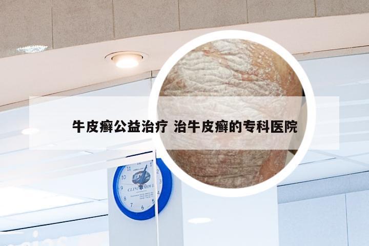 牛皮癣公益治疗 治牛皮癣的专科医院
