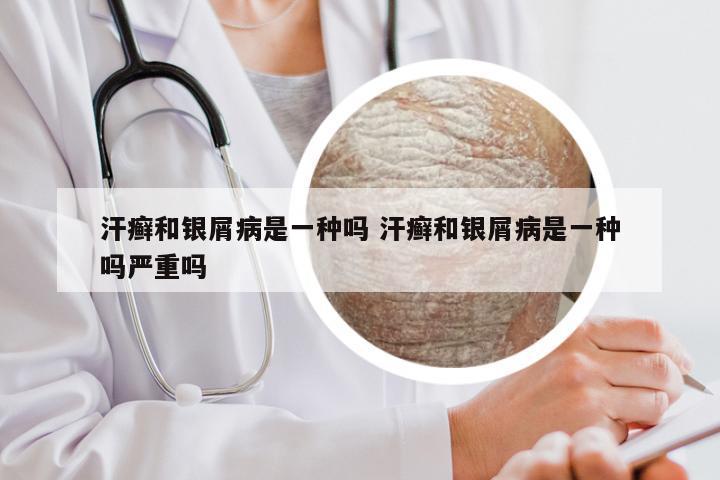 汗癣和银屑病是一种吗 汗癣和银屑病是一种吗严重吗