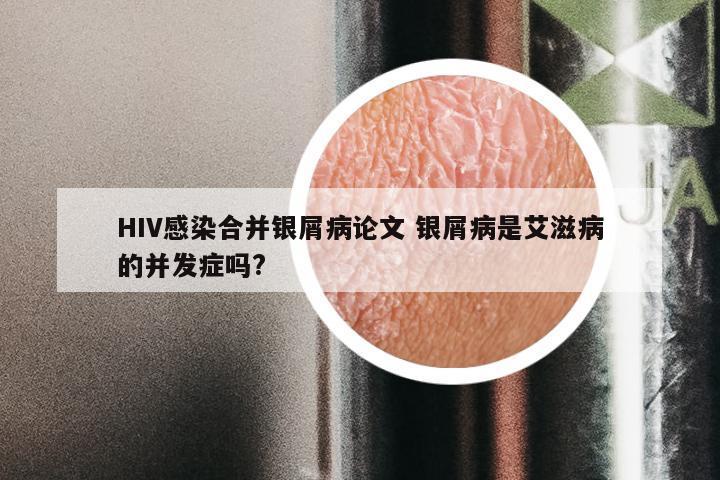 HIV感染合并银屑病论文 银屑病是艾滋病的并发症吗?