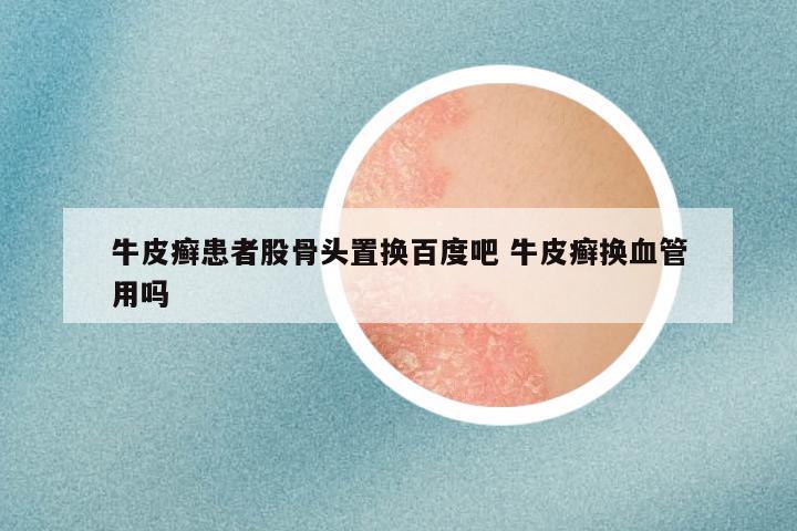 牛皮癣患者股骨头置换百度吧 牛皮癣换血管用吗