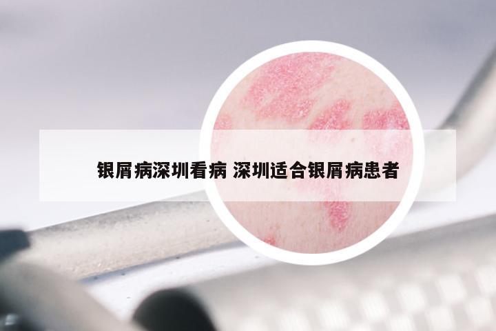 银屑病深圳看病 深圳适合银屑病患者