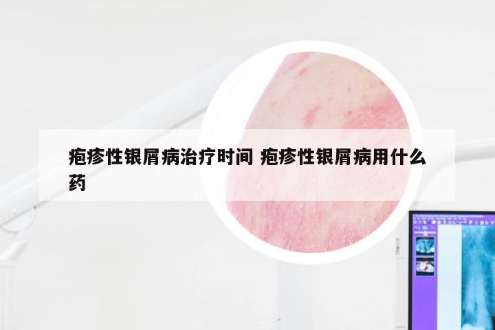 疱疹性银屑病治疗时间 疱疹性银屑病用什么药