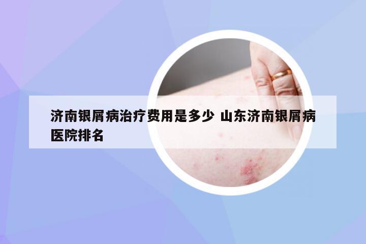 济南银屑病治疗费用是多少 山东济南银屑病医院排名