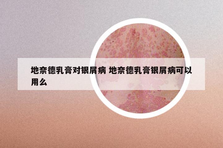 地奈德乳膏对银屑病 地奈德乳膏银屑病可以用么