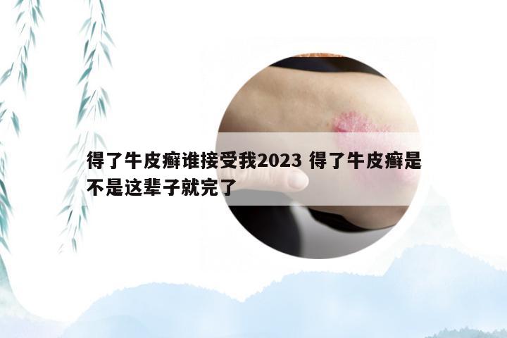 得了牛皮癣谁接受我2023 得了牛皮癣是不是这辈子就完了