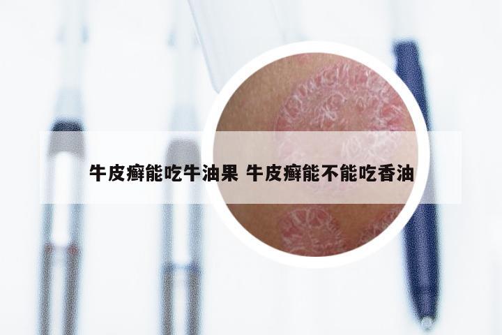 牛皮癣能吃牛油果 牛皮癣能不能吃香油