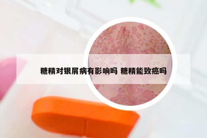 糖精对银屑病有影响吗 糖精能致癌吗