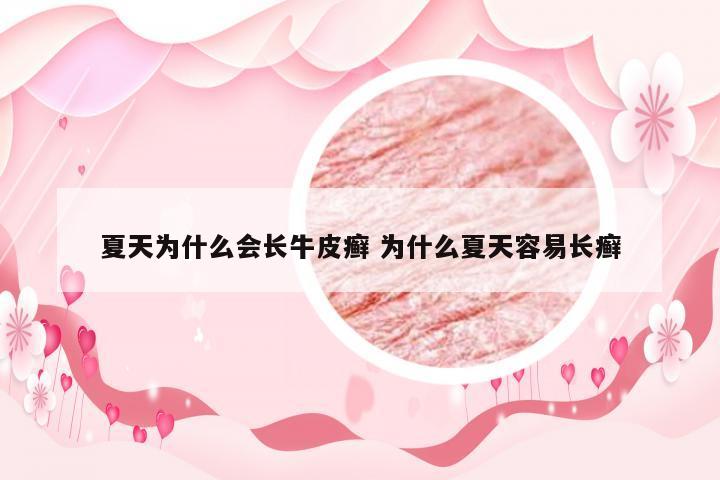 夏天为什么会长牛皮癣 为什么夏天容易长癣