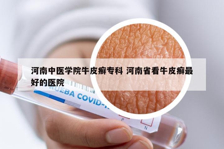 河南中医学院牛皮癣专科 河南省看牛皮癣最好的医院