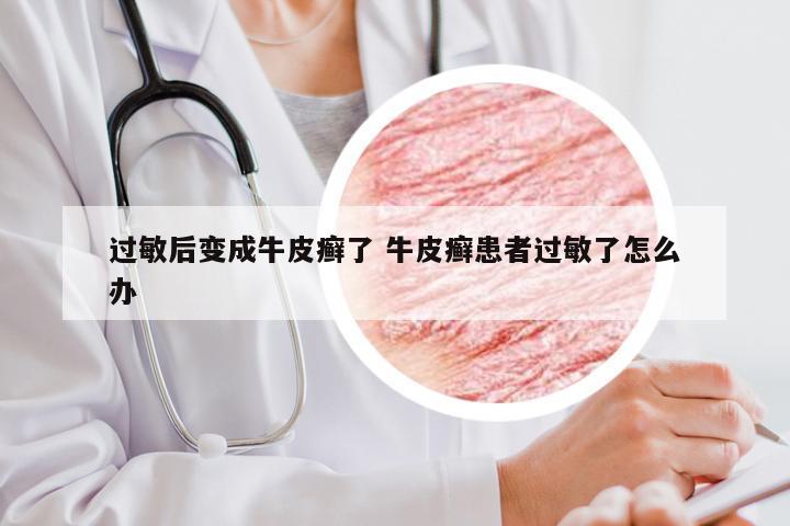 过敏后变成牛皮癣了 牛皮癣患者过敏了怎么办