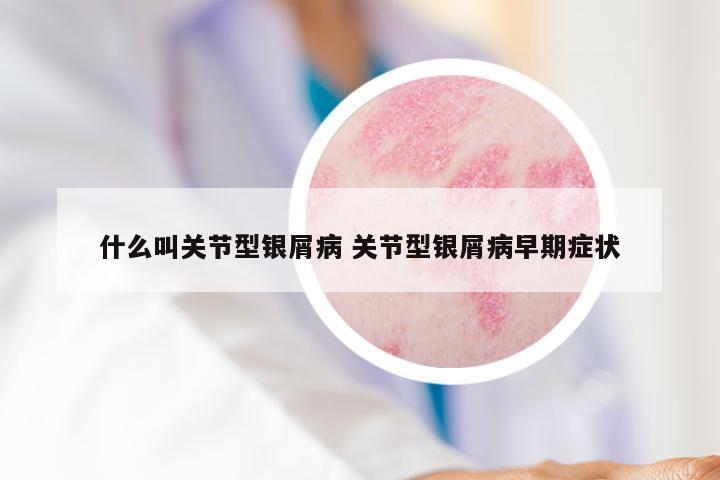 什么叫关节型银屑病 关节型银屑病早期症状