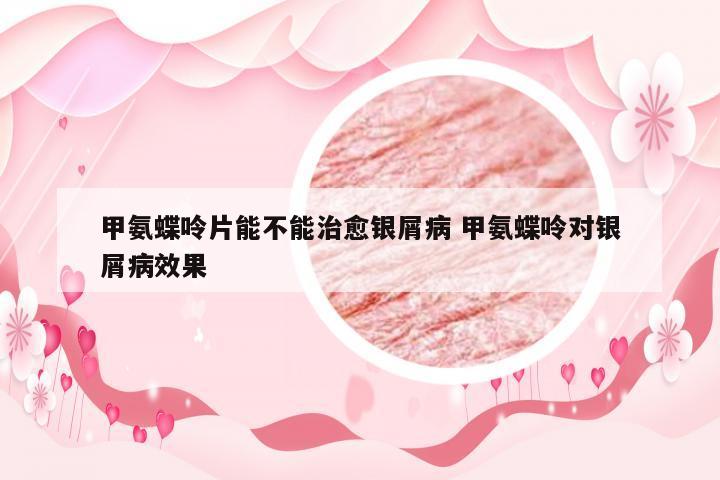 甲氨蝶呤片能不能治愈银屑病 甲氨蝶呤对银屑病效果