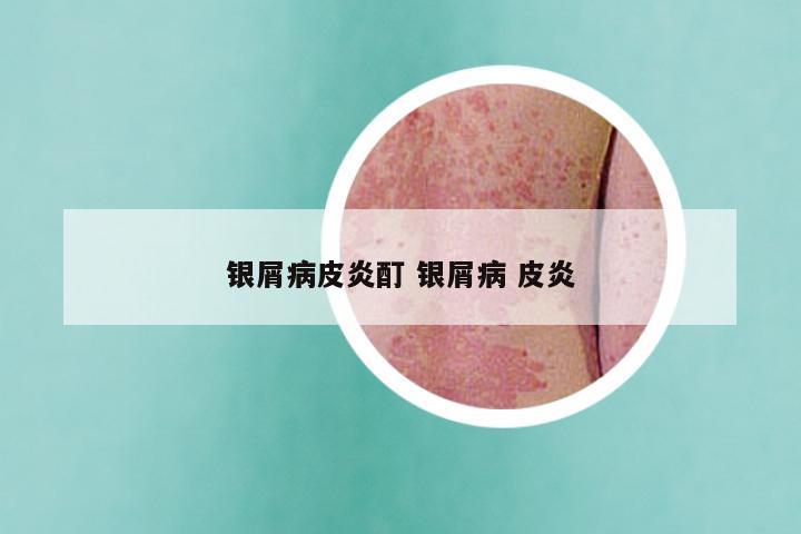银屑病皮炎酊 银屑病 皮炎