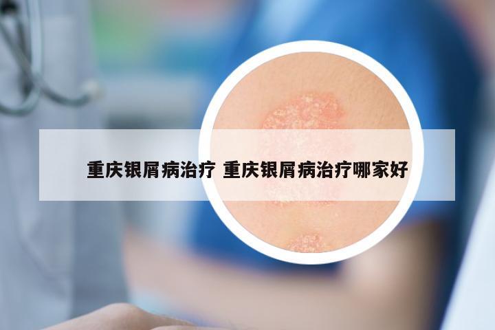 重庆银屑病治疗 重庆银屑病治疗哪家好