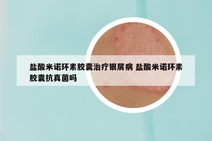 盐酸米诺环素胶囊治疗银屑病 盐酸米诺环素胶囊抗真菌吗