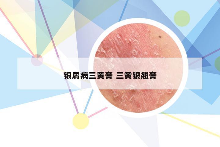 银屑病三黄膏 三黄银翘膏