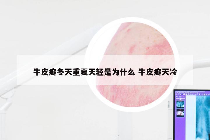 牛皮癣冬天重夏天轻是为什么 牛皮癣天冷