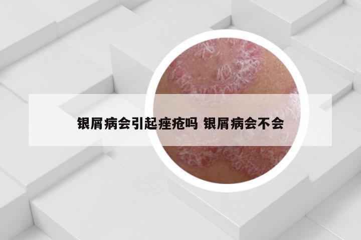 银屑病会引起痤疮吗 银屑病会不会