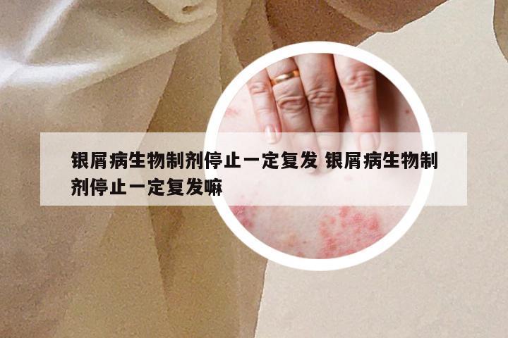 银屑病生物制剂停止一定复发 银屑病生物制剂停止一定复发嘛