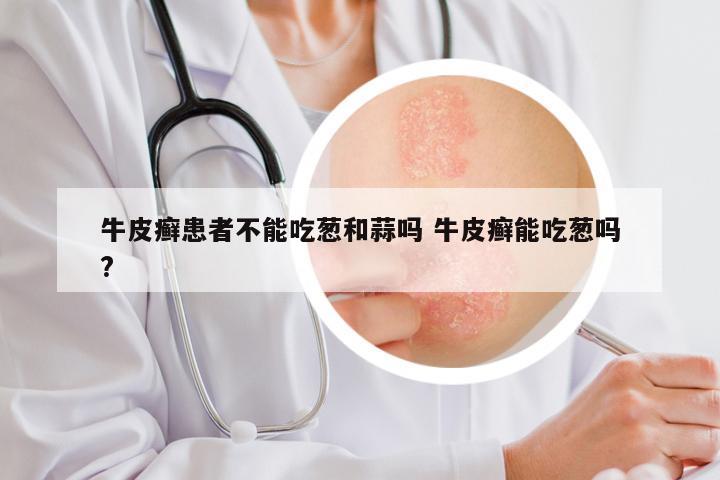 牛皮癣患者不能吃葱和蒜吗 牛皮癣能吃葱吗?