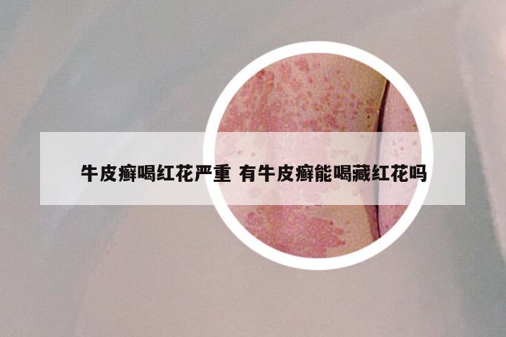 牛皮癣喝红花严重 有牛皮癣能喝藏红花吗