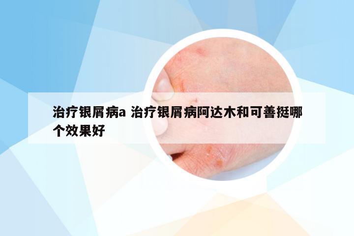 治疗银屑病a 治疗银屑病阿达木和可善挺哪个效果好