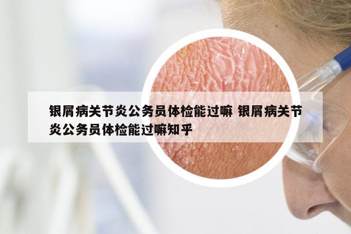银屑病关节炎公务员体检能过嘛 银屑病关节炎公务员体检能过嘛知乎
