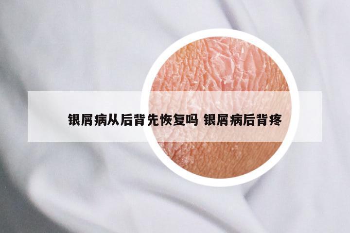 银屑病从后背先恢复吗 银屑病后背疼