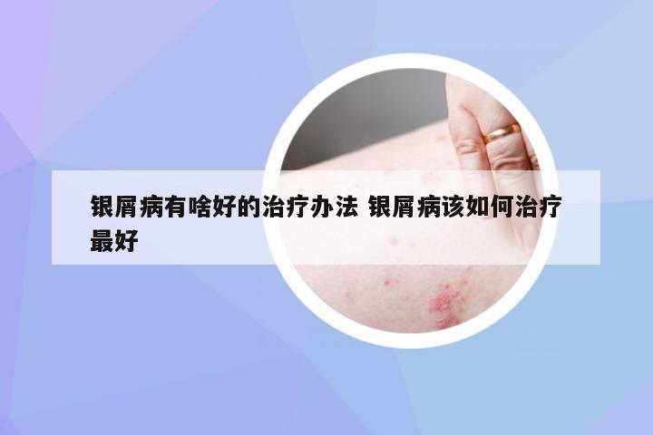 银屑病有啥好的治疗办法 银屑病该如何治疗最好