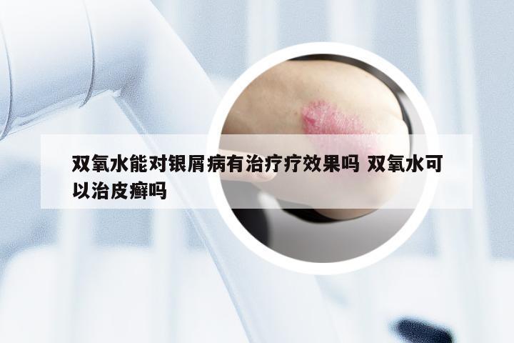 双氧水能对银屑病有治疗疗效果吗 双氧水可以治皮癣吗