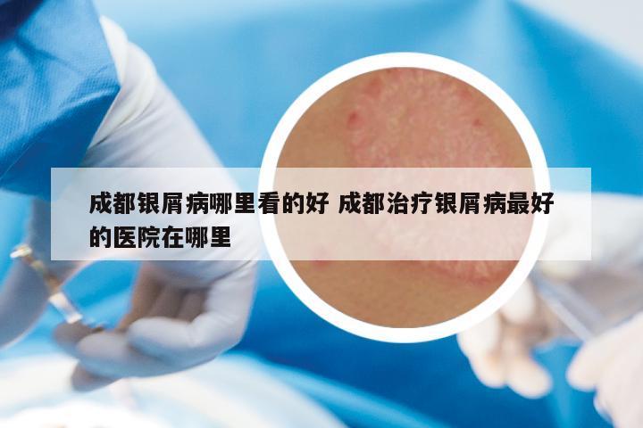 成都银屑病哪里看的好 成都治疗银屑病最好的医院在哪里
