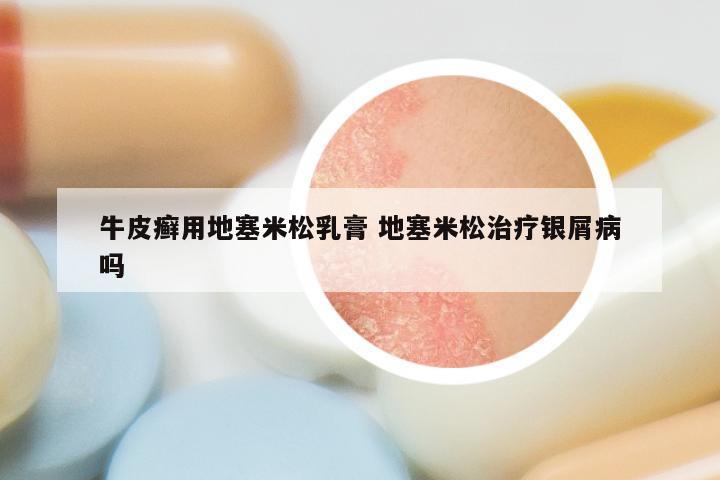 牛皮癣用地塞米松乳膏 地塞米松治疗银屑病吗