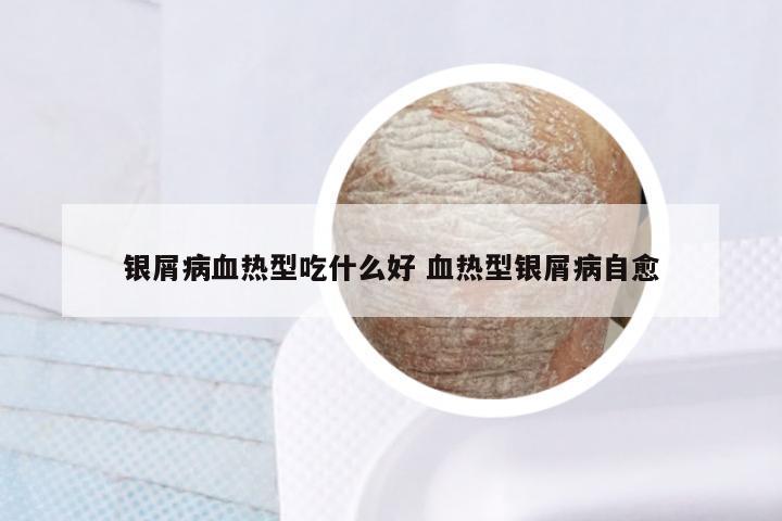 银屑病血热型吃什么好 血热型银屑病自愈