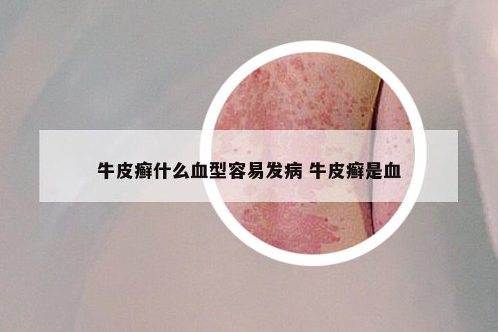 牛皮癣什么血型容易发病 牛皮癣是血