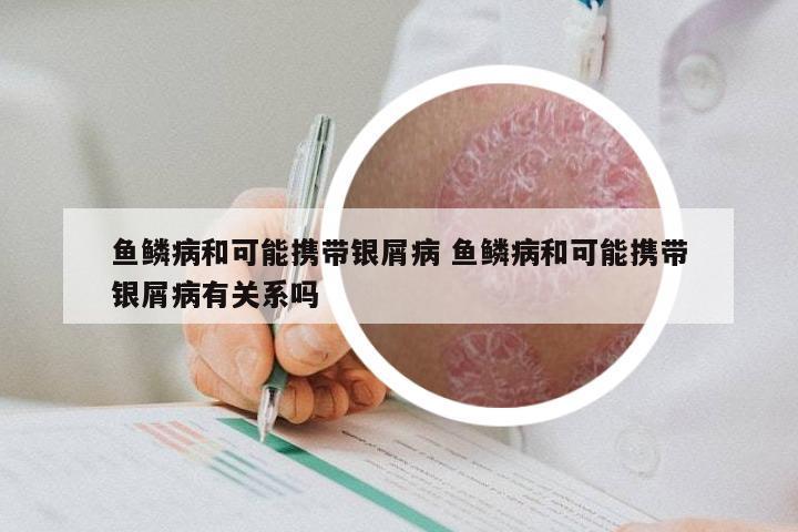 鱼鳞病和可能携带银屑病 鱼鳞病和可能携带银屑病有关系吗